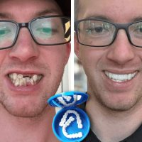 Exploring Trustworthy Pop On Veneers Reviews